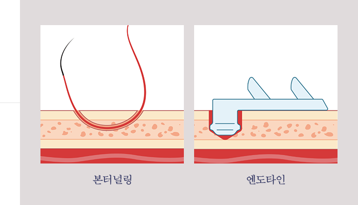 고정 방법 예시