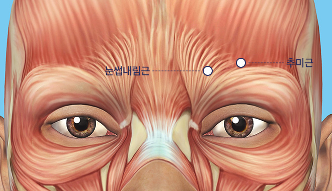 추미근과 눈썹 내림근 절제