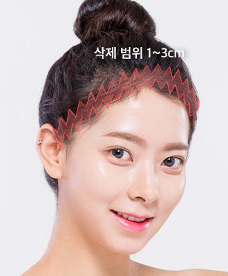 미니 리프팅 STEP 2 이미지