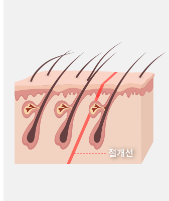 미니 리프팅 STEP 3 이미지